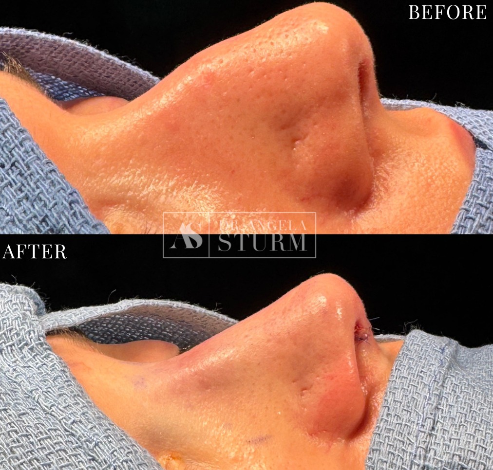 rhinoplasty, rhinoplasty before and after, rhinoplasty surgeon, revision rhinoplasty, rhinoplasty expert, nose job, nose job houston, houston rhinoplasty, houston nose job, houston plastic surgeon