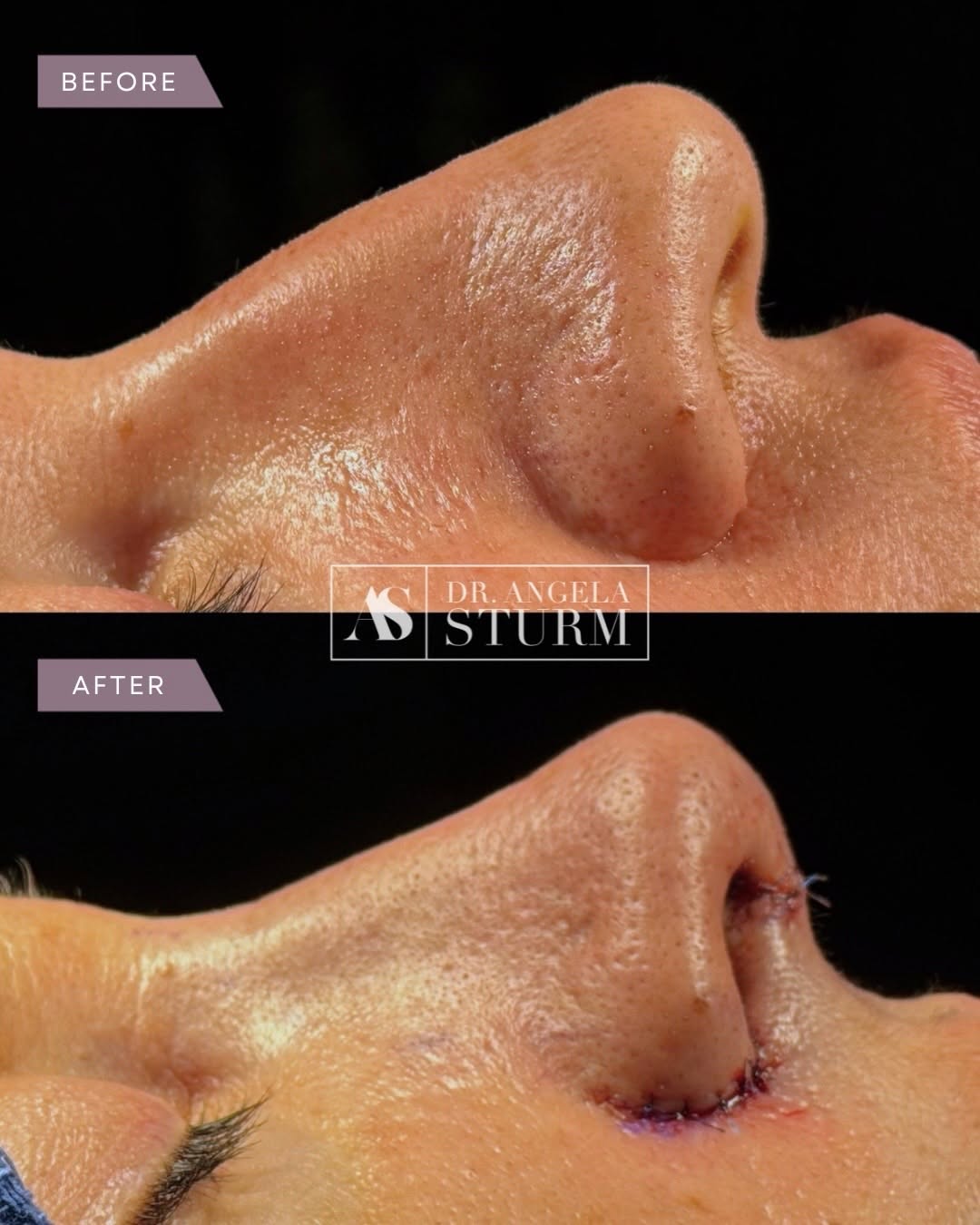 Instagram post by Dr. Angela Sturm: Who’s actually a candidate for rhinoplasty? More people than you’d think. 👃 Rhinoplasty is used to address a wide range of concerns, includ…