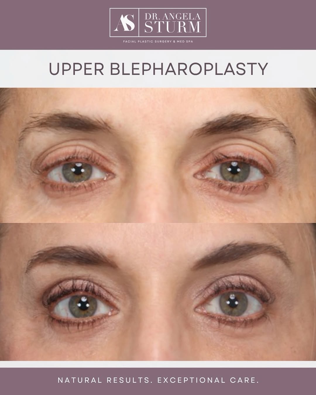 Instagram post by Dr. Angela Sturm: Upper eyelids that finally match how awake you feel 🤩 Upper blepharoplasty removes excess, heavy skin on the upper eyelid — often the culpr…