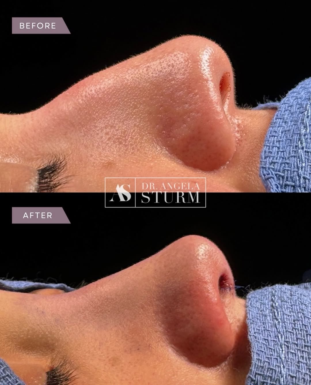 Instagram post by Dr. Angela Sturm: This patient came to us wanting a softer, more feminine nose — refined and proportionate to the rest of her face, without losing what made h…