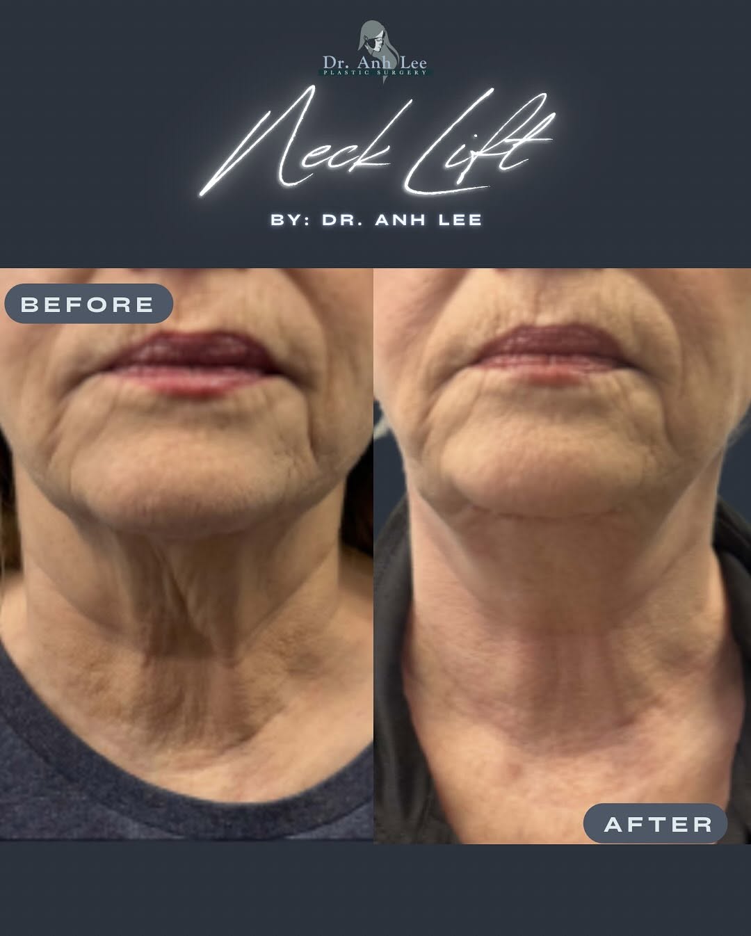 Instagram post by Dr. Anh Lee: A subtle lift. A defined neckline. A refreshed profile. Neck lift results designed to look natural and timeless. #NeckLift #NeckLiftResults …