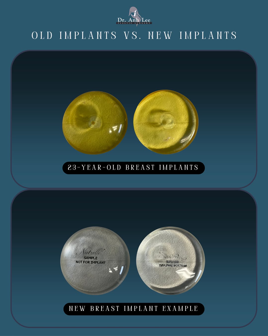 Instagram post by Dr. Anh Lee: What can 23 years look like?👀 These breast implants were removed after being in place for 23 years. What you’re seeing is significant calci…