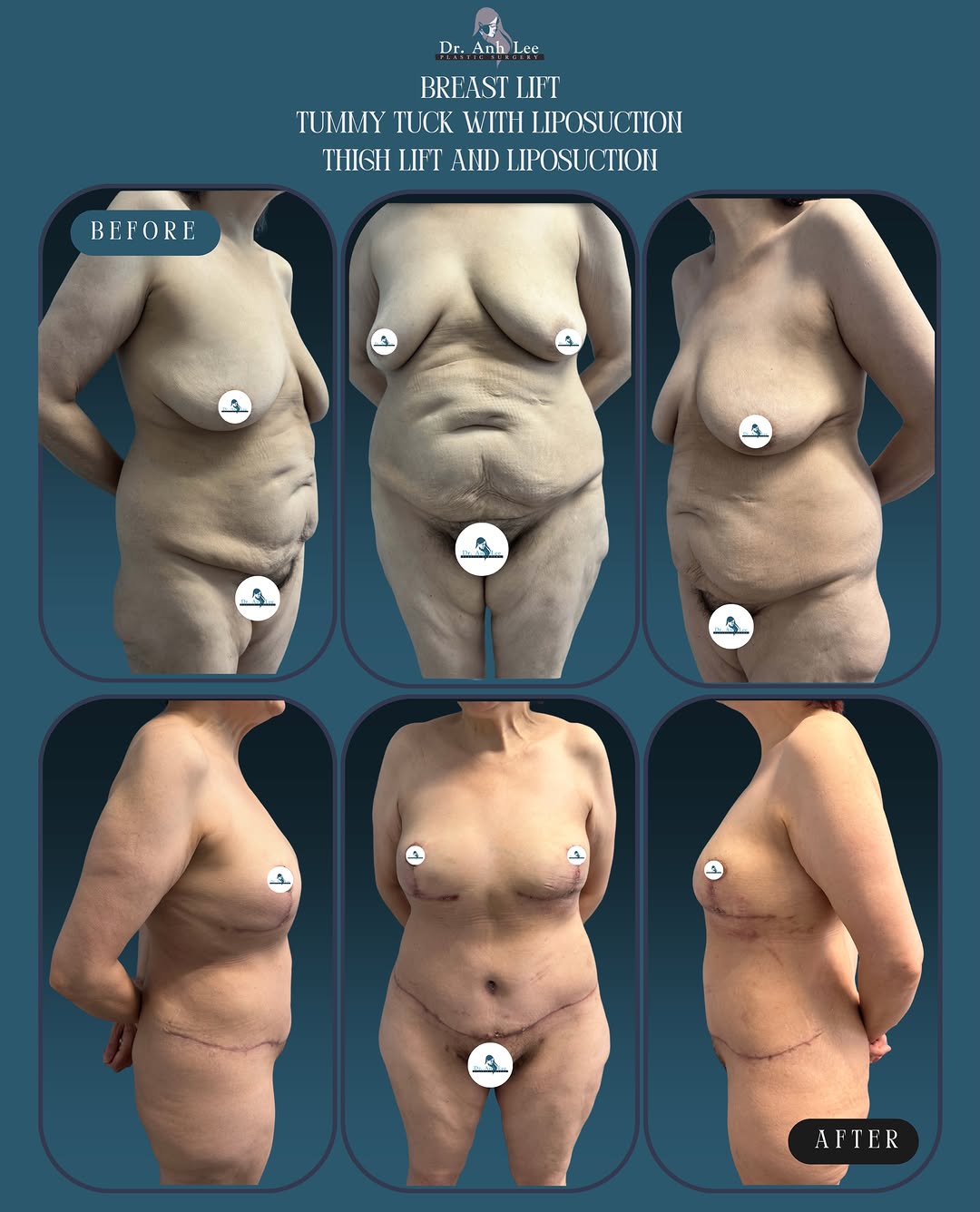 Instagram post by Dr. Anh Lee: ✨A Beautiful Transformation✨ A combination of procedures designed to enhance shape, contour, and overall proportions: ⭐️Breast Lift - lift a…