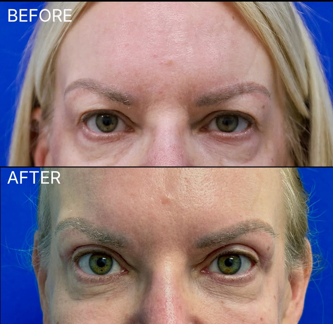 Instagram post by Dr. Anisha Kumar: This lovely patient wanted to address the hooding of her upper eyelids. After an upper blepharoplasty, she looks refreshed and alert! #DrAni…