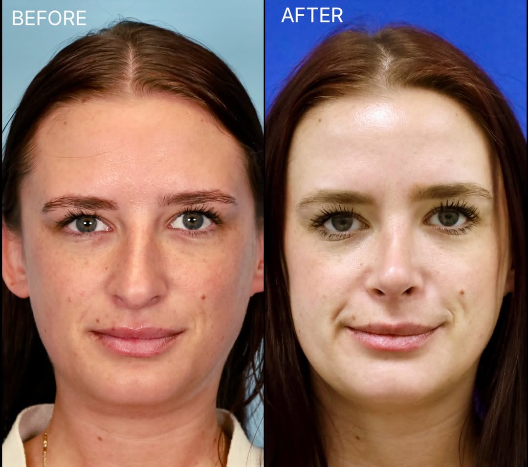 Instagram post by Dr. Anisha Kumar: This stunning patient wanted to improve her nasal breathing and also address the dorsal hump, decrease the nasal projection, and refine the …