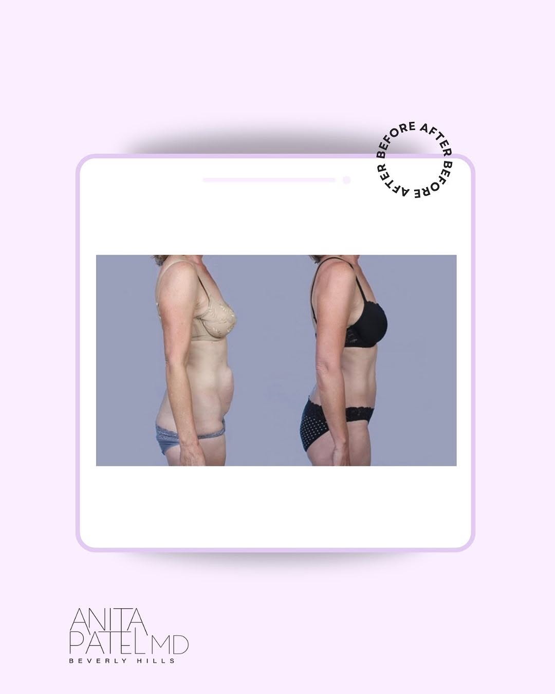 Instagram post by Dr. Anita Patel: For many women, the midsection can be one of the most frustrating areas, especially after weight changes, pregnancy, or just the natural cha…