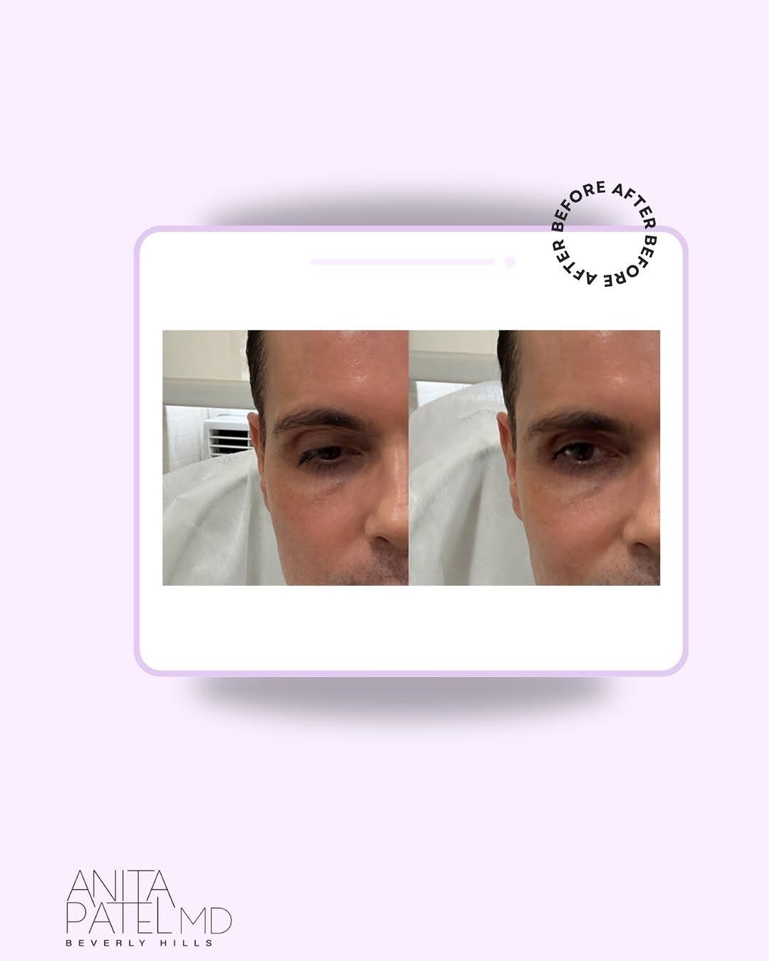 Instagram post by Dr. Anita Patel: Not every before-and-after needs to be dramatic. In this case, Renuva was used in the temples to restore a small amount of lost support and …