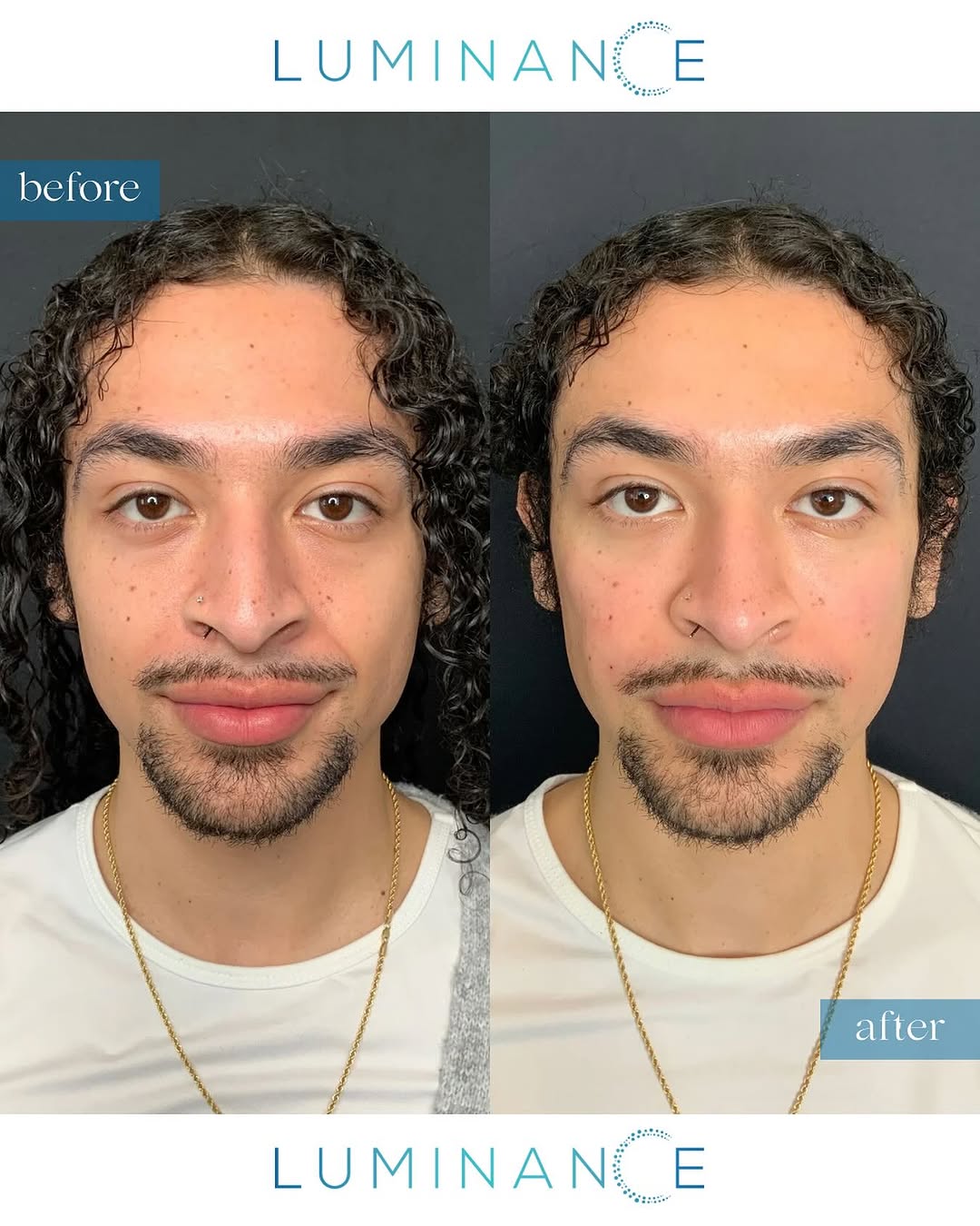 Instagram post by Dr. Anjali Dhar: Instant glow up with EZ Gel PRF! ✨ We treated the undereyes, cheeks, and nasolabial folds, you can instantly see brighter under eyes and smo…