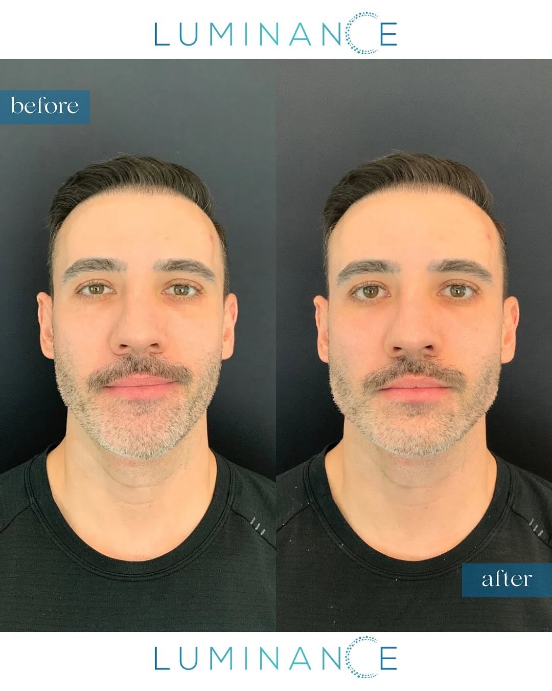 Instagram post by Dr. Anjali Dhar: Sometimes it’s the small, strategic enhancements that make the biggest difference. 💫 Jawline definition achieved with Juvederm Voluma + Vol…