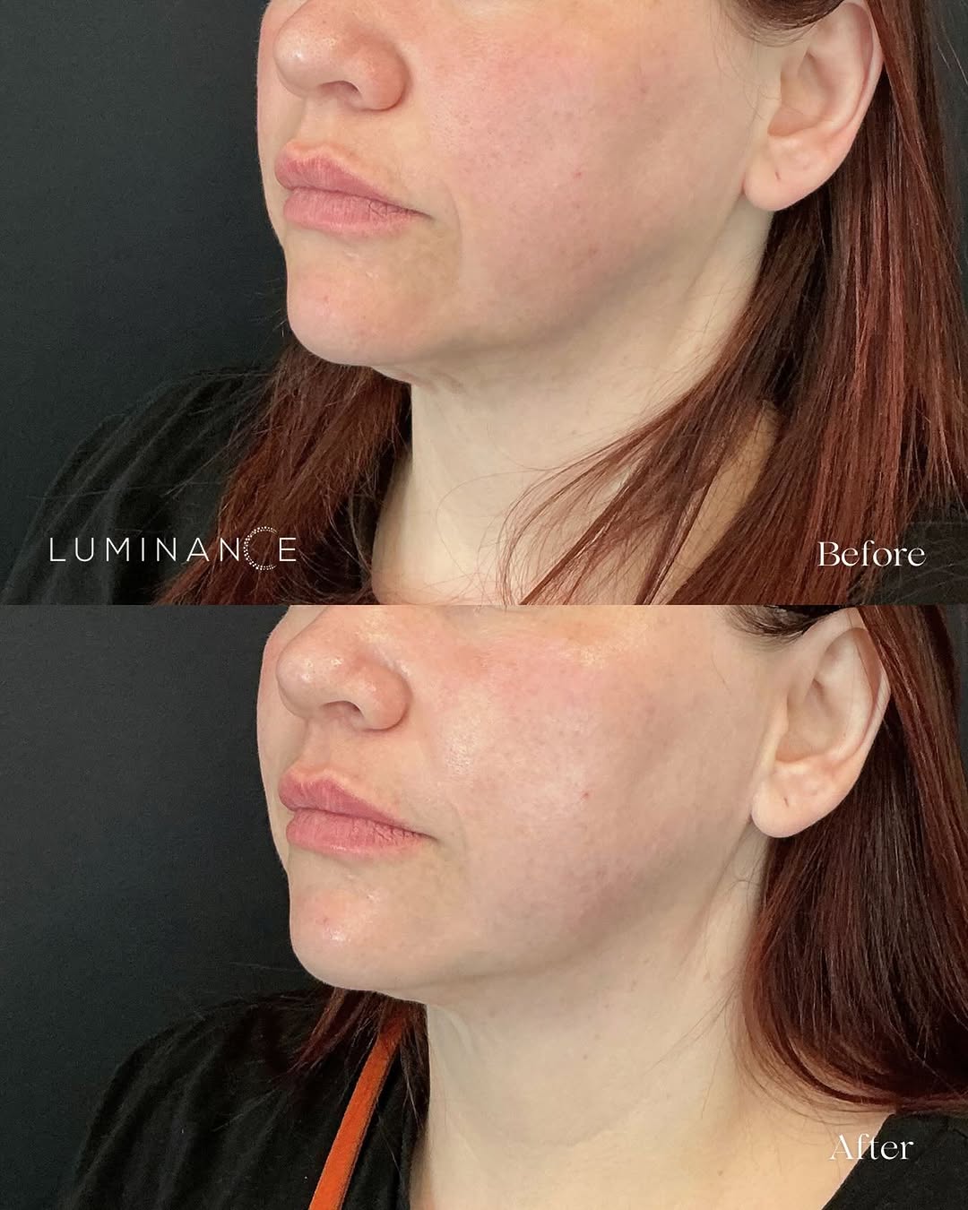 Instagram post by Dr. Anjali Dhar: One session of XERF Lower Face These results were captured immediately after treatment, with continued improvement over time as new collagen…