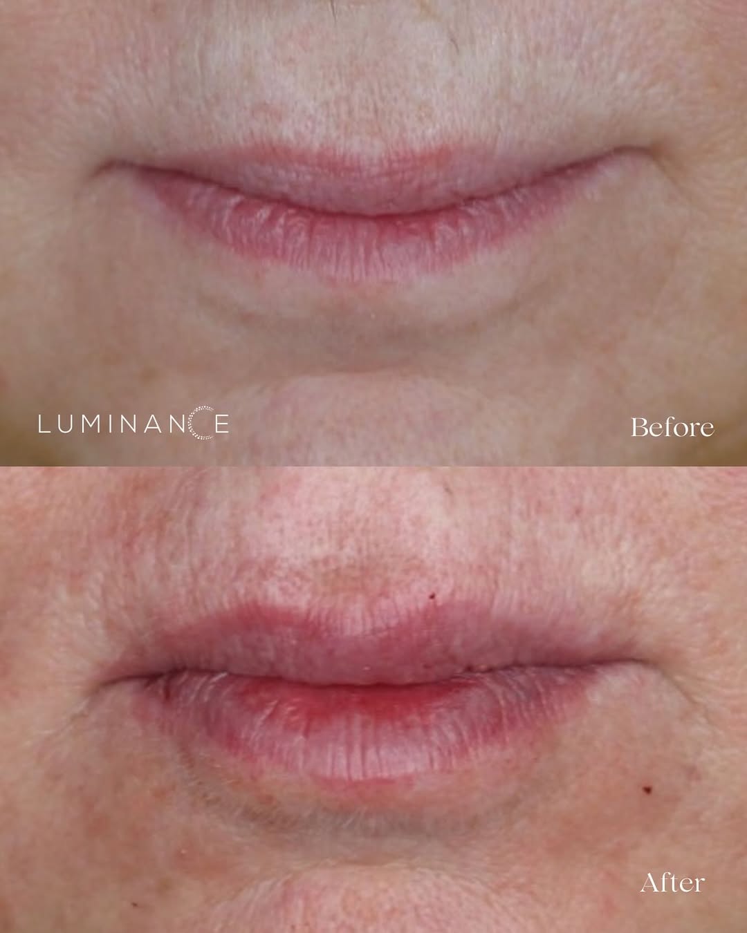 Instagram post by Dr. Anjali Dhar: Before → After ✨ Lip filler by Dr. Dhar A subtle enhancement for added volume and definition while keeping the lips looking natural. Ready f…