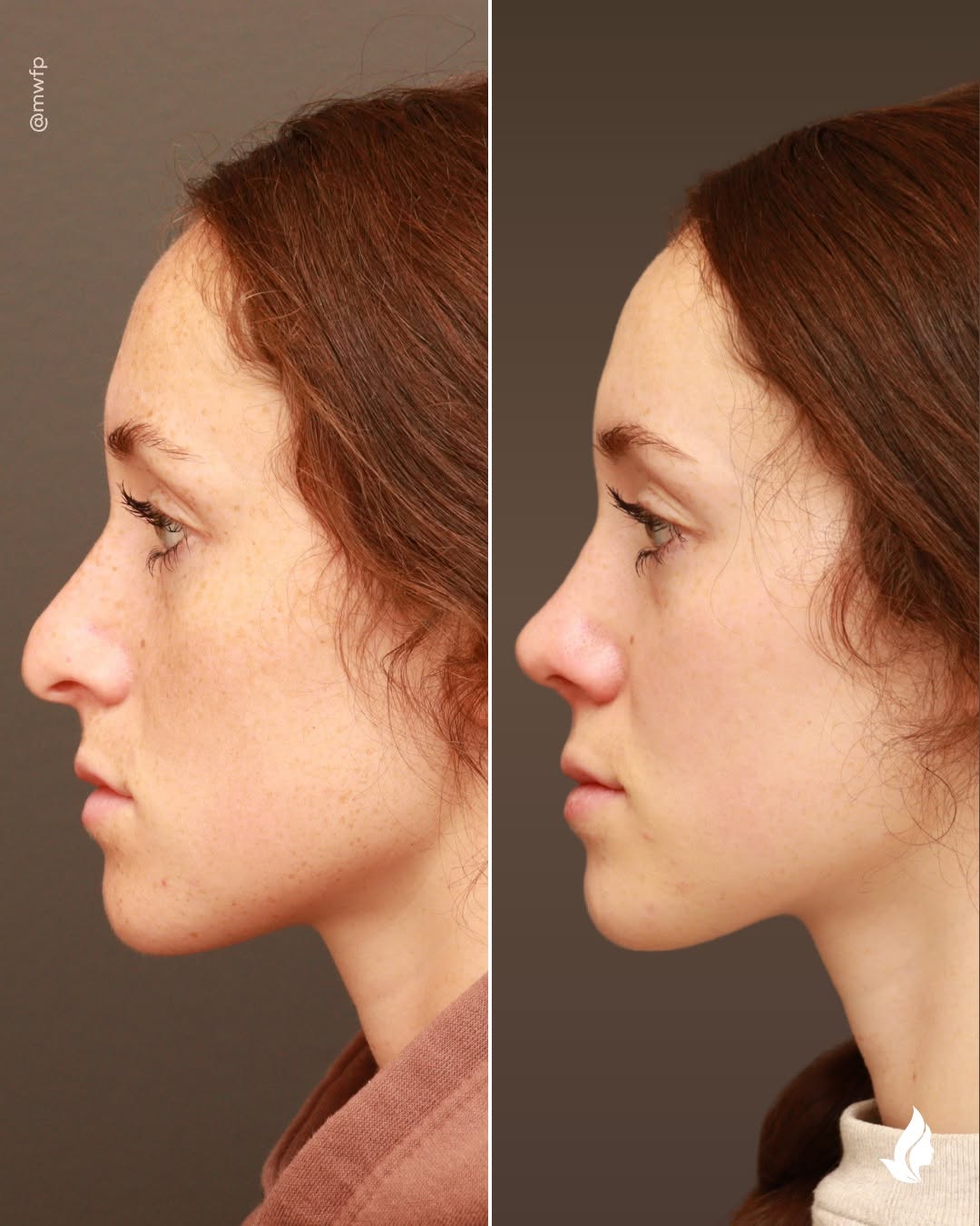Instagram post by Dr. Anna Bakeman: One of the biggest misconceptions about rhinoplasty is that you can change just one part of the nose. In reality, every change affects the o…