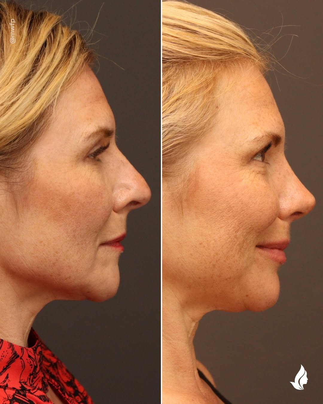 Instagram post by Dr. Anna Bakeman: This patient wanted a smaller nose with a softer, more feminine profile. Three months out from surgery with @annabakemanmd, we love how her …