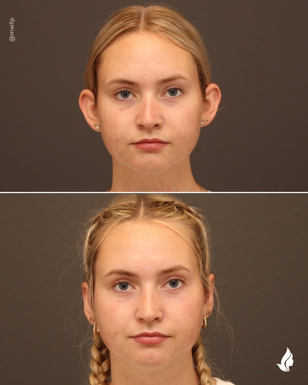 Instagram post by Dr. Anna Bakeman: The goal of a well-performed otoplasty is to restore balance so the ears no longer draw unwanted attention, bringing the focus to the rest o…