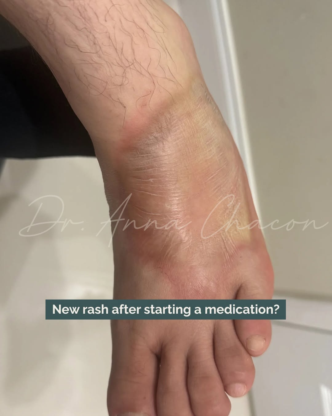 Instagram post by Dr. Anna Chacon: A skin change can have more than one clue behind it. 👀 When something new appears, I look beyond what the skin shows me. Recent medications…