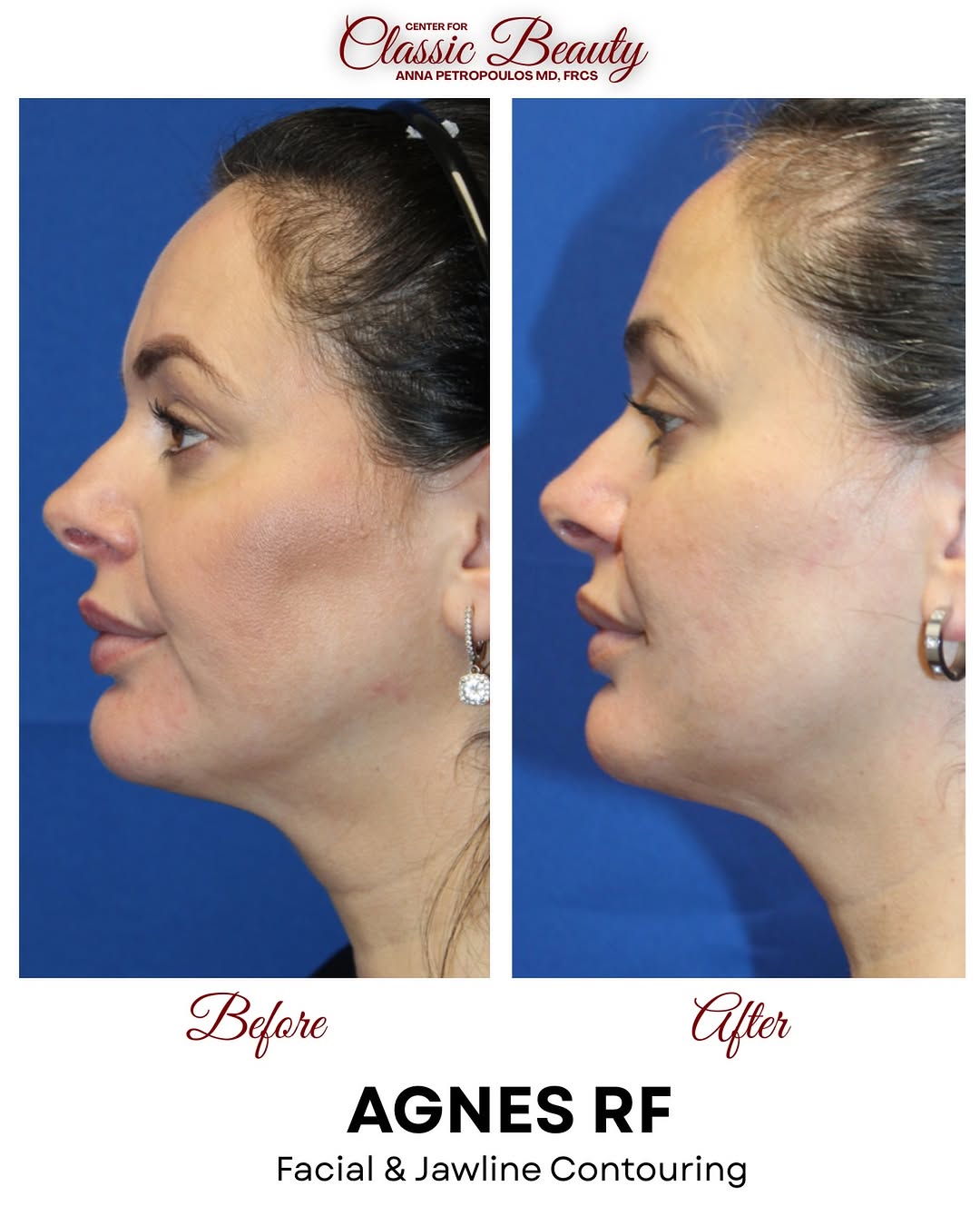 Instagram post by Dr. Anna Petropoulos: A More Refined Profile Without Surgery AGNES RF precisely targets unwanted fat beneath the chin while tightening the surrounding skin for a …