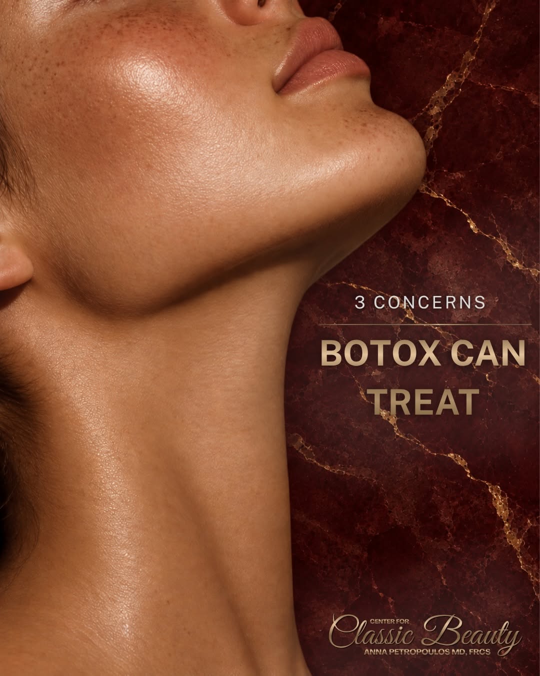 Instagram post by Dr. Anna Petropoulos: Botox Can Do More Than Soften Fine Lines & Wrinkles When precisely placed, it can also reduce the appearance of prominent neck bands and hel…