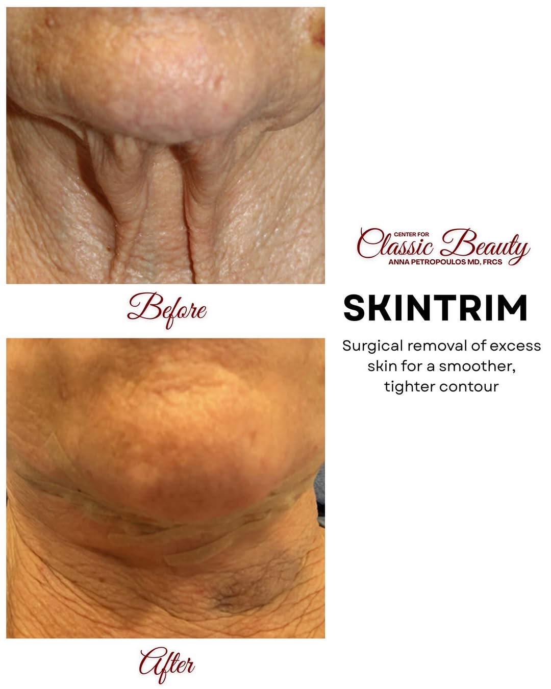 Instagram post by Dr. Anna Petropoulos: Smoother. Tighter. More confident. A refined contour with surgical removal of excess skin—creating a smoother, tighter appearance while main…