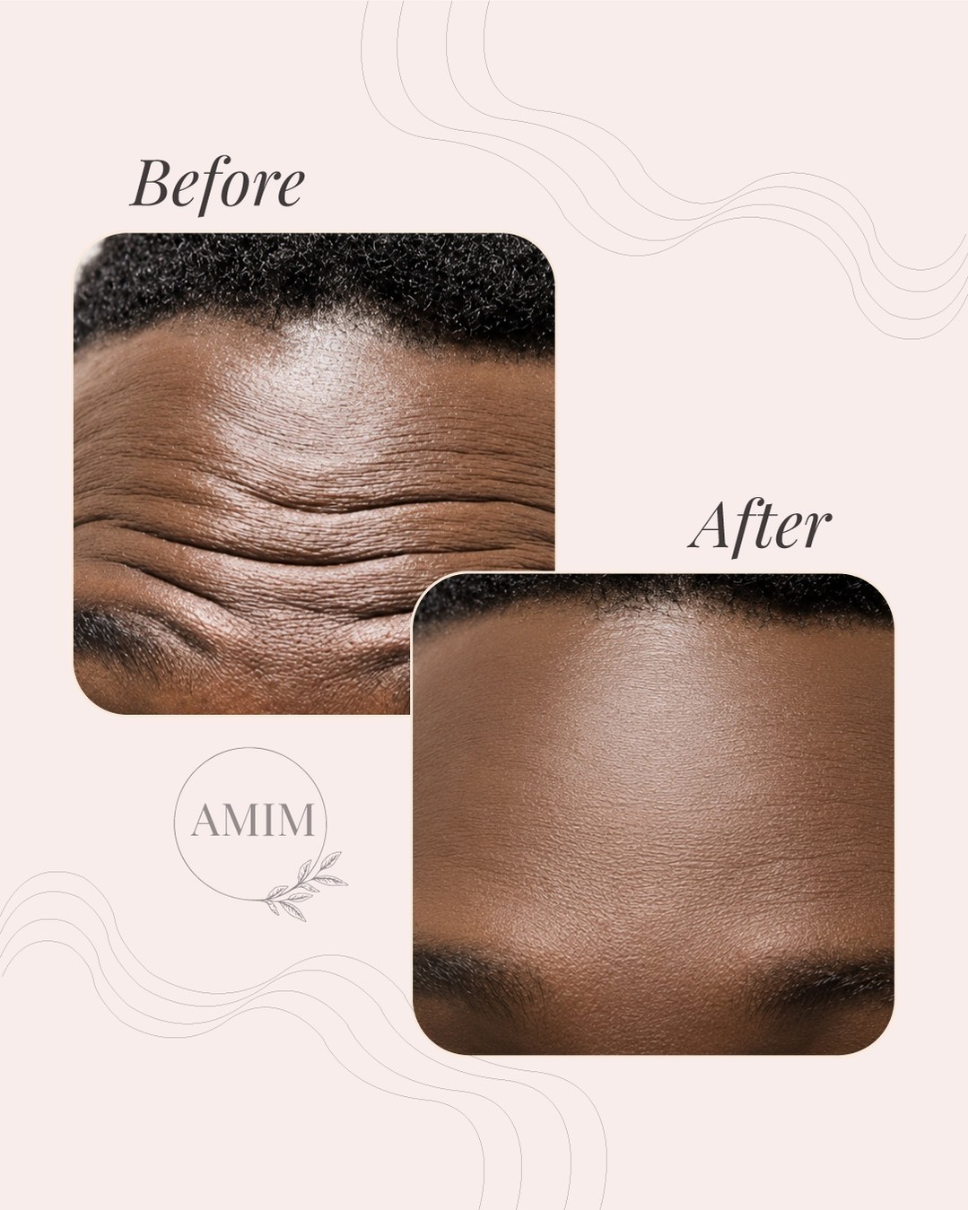 Instagram post by Dr. Anna Sottile: Every face tells a story, and every result begins with a personalized approach. ✨ This transformation highlights the effect of targeted aest…
