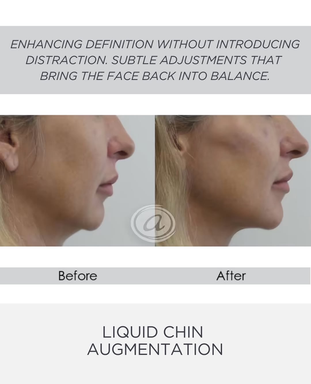 Instagram post by Dr. Annie Chiu: Subtle support. Stronger profile. Still entirely you.🤍 A liquid chin augmentation isn’t about simply “adding volume.” It’s about strategic …