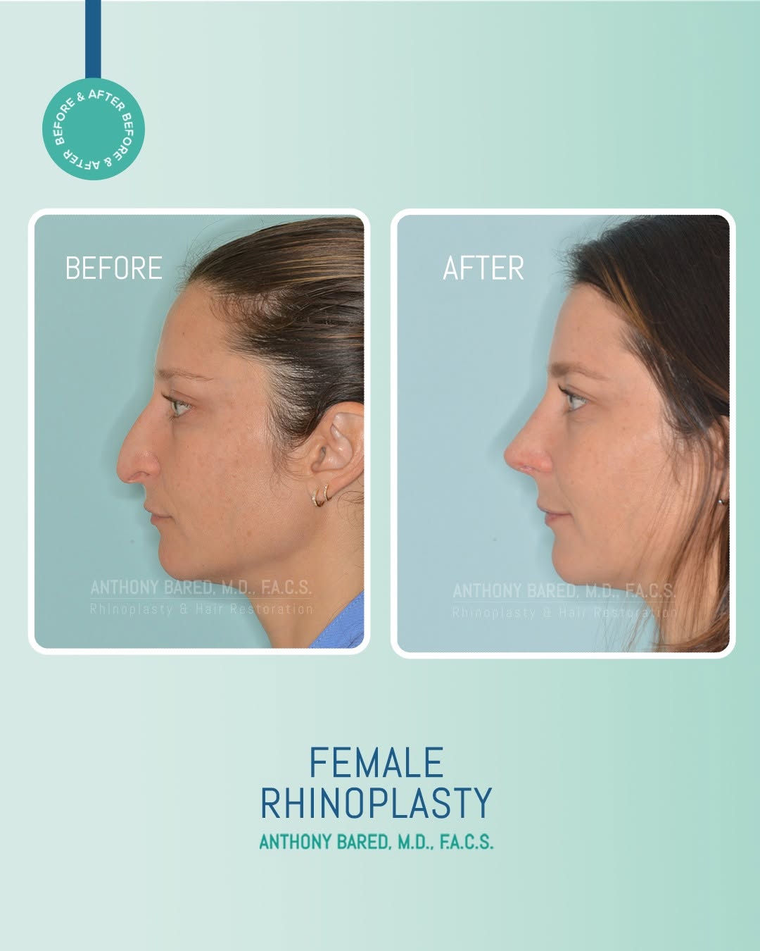Instagram post by Dr. Anthony Bared: Just one month after her rhinoplasty, this patient is looking gorgeous. 📲Call the office at 305-680-3049 to learn more about Dr. Bared's rh…
