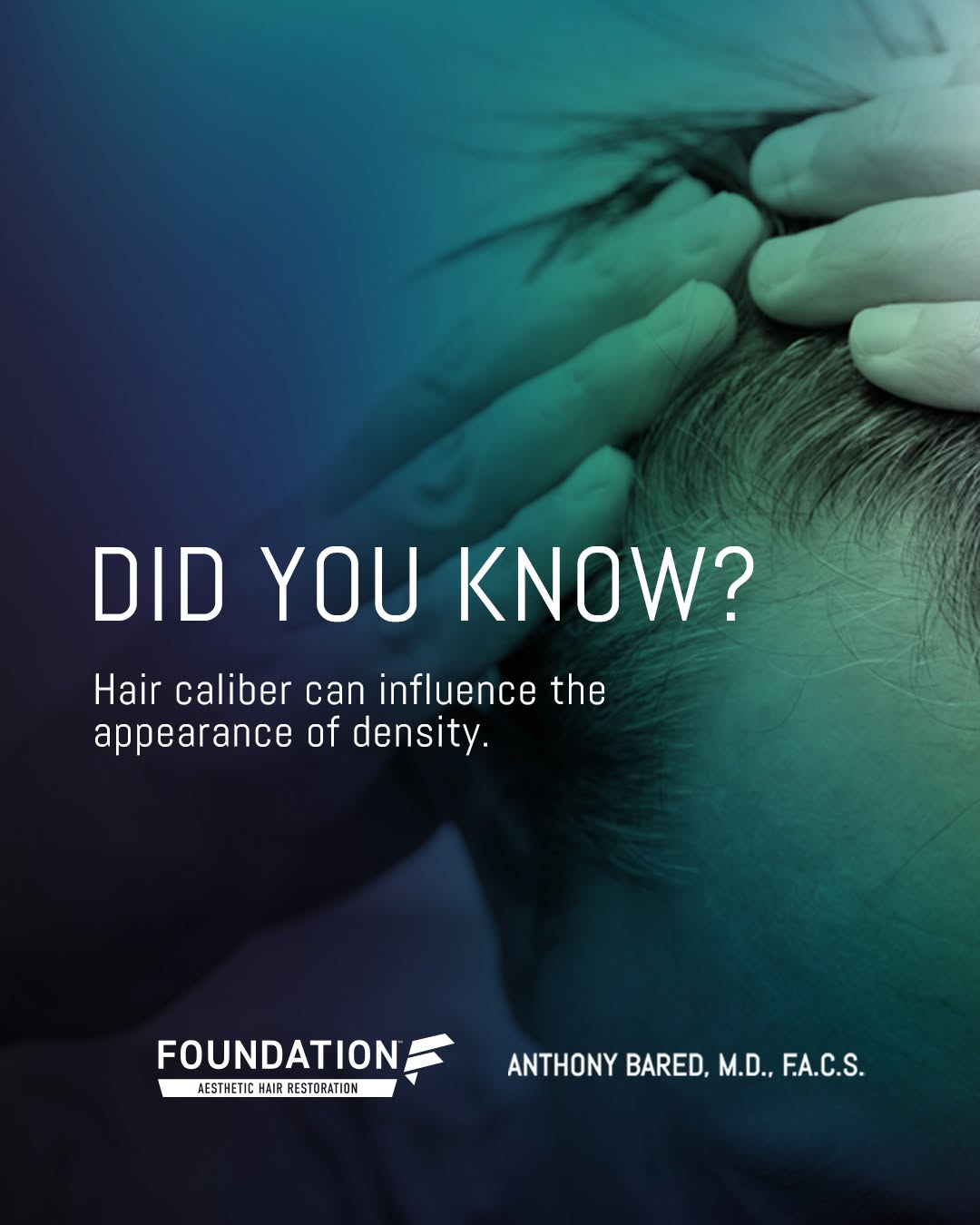 Instagram post by Dr. Anthony Bared: Two patients can receive a similar number of transplanted follicles and achieve visually different levels of coverage. Why? One important fa…