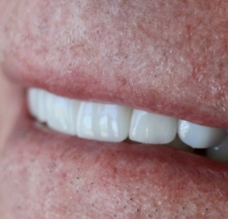 Instagram post by Dr. Anthony Edward Marra, DDS: 55 #huntersvillefamilyandcosmeticdentistry #dentistry #dentalimplants #fullmouthrehab #speareducation #spearsummit #leadership #dentalintell…