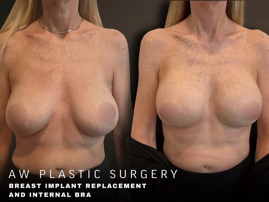 Instagram post by Dr. Anthony J. Wilson: ✨Implant malposition can occur years after breast augmentation as tissues stretch and implant support weakens. This patient developed inferi…