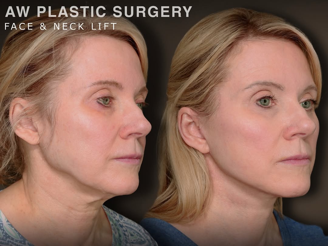 Instagram post by Dr. Anthony J. Wilson: Let’s take a moment for the ¾ angle. This view tells so much of the story after a deep plane facelift—especially through the jowls, jawline,…