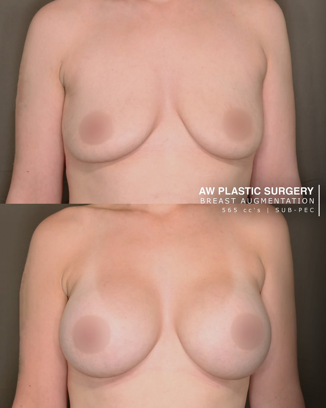 Instagram post by Dr. Anthony J. Wilson: There’s no one “right” size when it comes to breast augmentation—and that’s exactly the point. While we’re seeing more patients gravitate to…