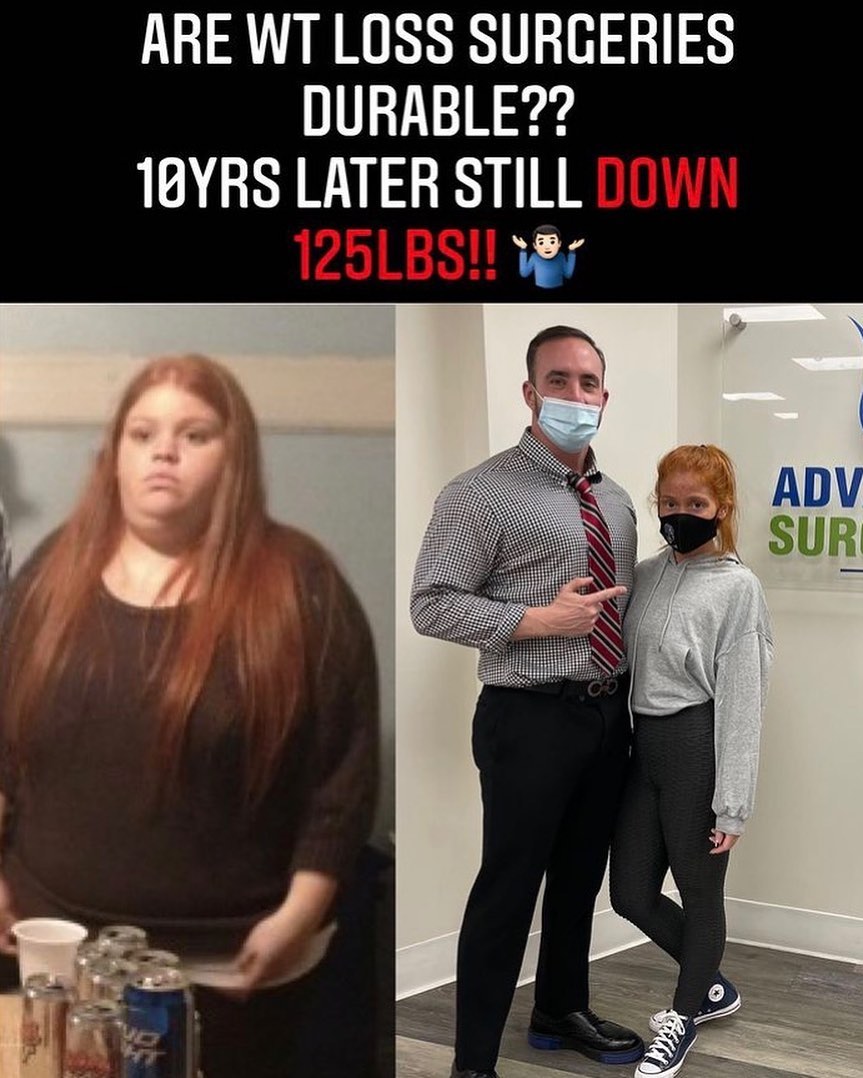 Instagram post by Dr. Anthony Maffei: SUCCESS STORY ALERT 🚨 10 years later, still walking the walk, still down 125 pounds! Gastric bypass surgery, with Dr. Anthony Maffei, at ag…