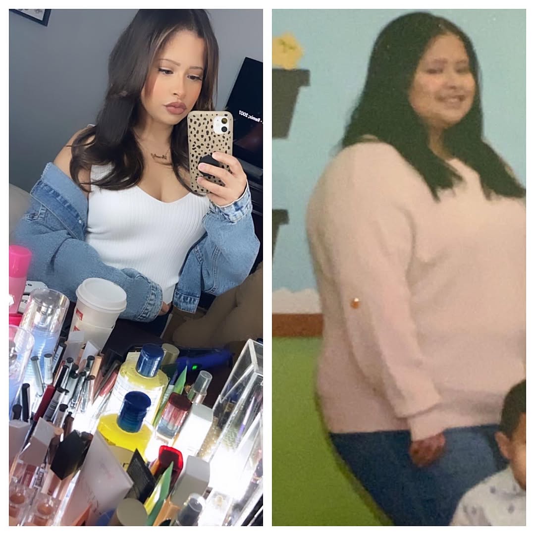 Instagram post by Dr. Anthony Maffei: 🚨🚨🚨Success story alert 💪👀 From 242 pounds down to 147 pounds! Down a total of 95 pounds! She is feeling amazing and loves to go to the …