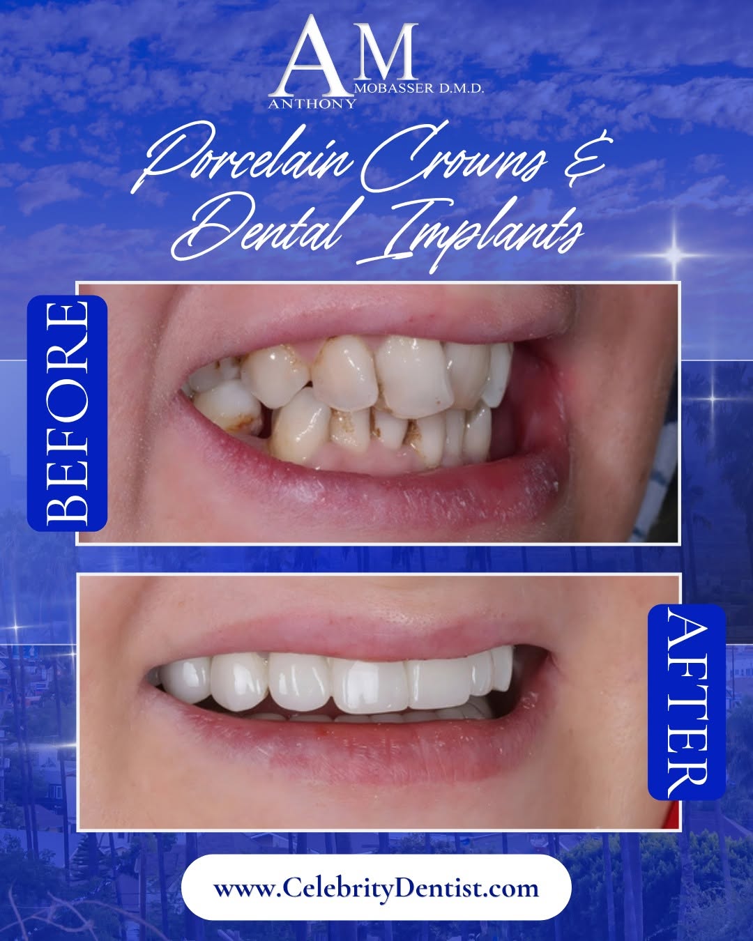 Instagram post by Dr. Anthony Mobasser, DDS, D: Porcelain crowns and dental implants can serve very different functions, but in the right treatment plan, they can work together to create a…