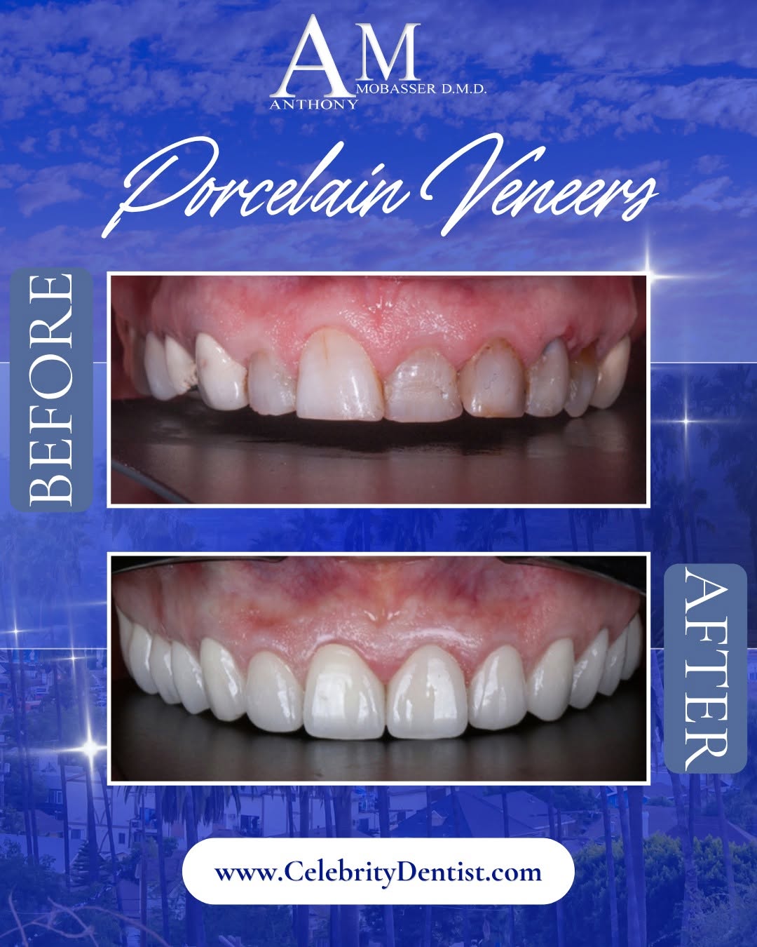 Instagram post by Dr. Anthony Mobasser, DDS, D: The assignment: brighter, smoother, beautifully balanced. ✨ These custom porcelain veneers refine the color, shape, and proportions of each …