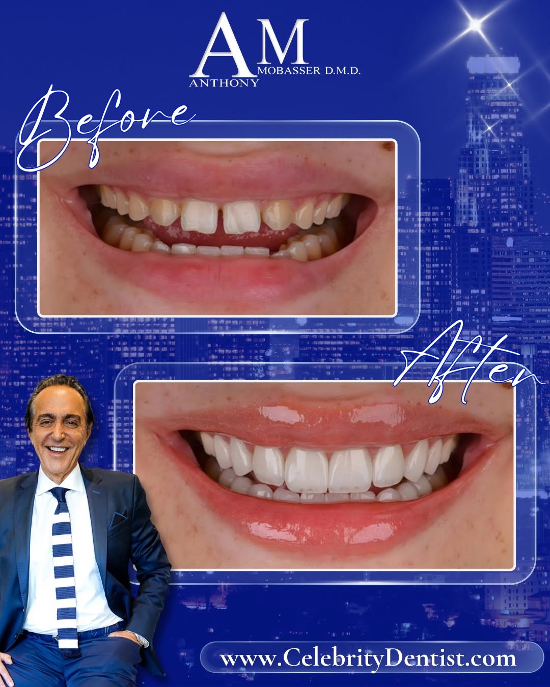 Instagram post by Dr. Anthony Mobasser, DDS, D: Sometimes the biggest difference comes from restoring what a smile has lost over time. In this case, Dr. Mobasser addressed worn, uneven, an…