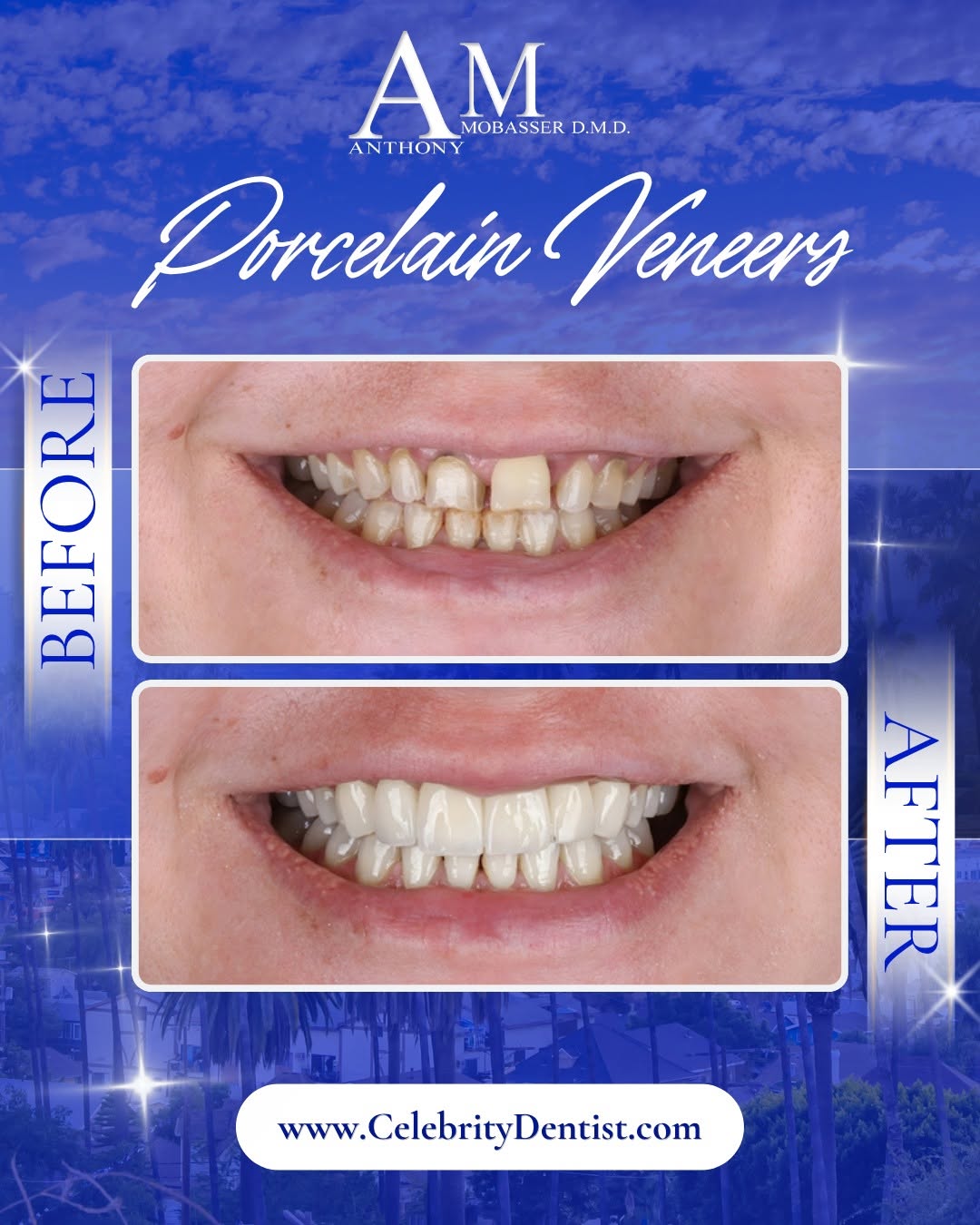 Instagram post by Dr. Anthony Mobasser, DDS, D: Porcelain veneers can change the way a smile comes together without making every tooth look exactly the same. For this before and after, Dr.…