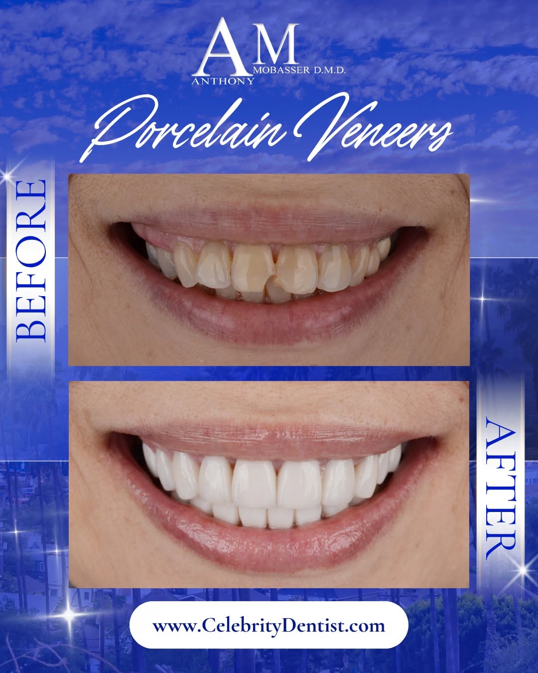 Instagram post by Dr. Anthony Mobasser, DDS, D: ✨ A full smile transformation gives a cosmetic dentist dozens of decisions to make. How long should the central incisors be? How should the …