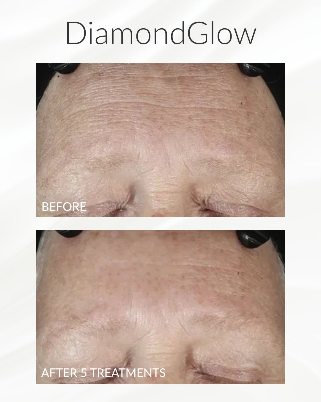 Instagram post by Dr. Anthony P. Terrasse: Does DiamondGlow actually work? Take a look at these results and see for yourself! This transformation followed 5 DiamondGlow treatments pai…