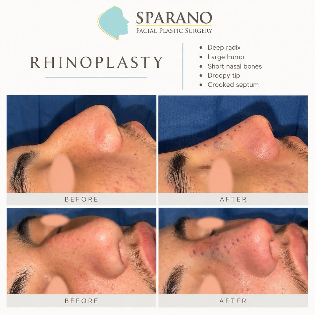 Instagram post by Dr. Anthony Sparano: Masculine preservation for this challenging nose on this handsome, young man. #SparanoNose #NaturalNose #SparanoBeforeAndAfter #NaturalFace …
