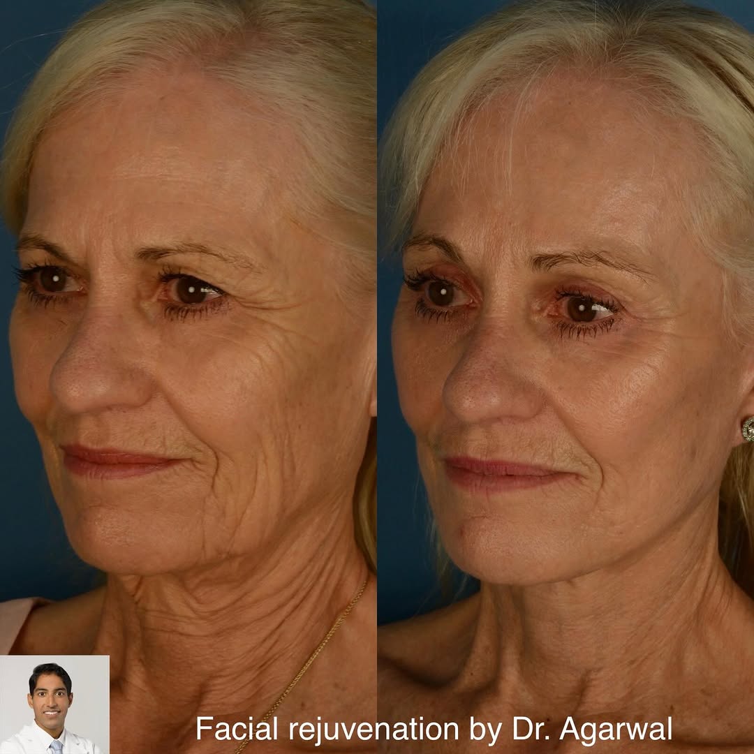Instagram post by Dr. Anurag Agarwal: I was excited to see my 68 year old patient yesterday, who is shown before and 8 months after I performed an: ✅ Endoscopic brow lift ✅ Upper…