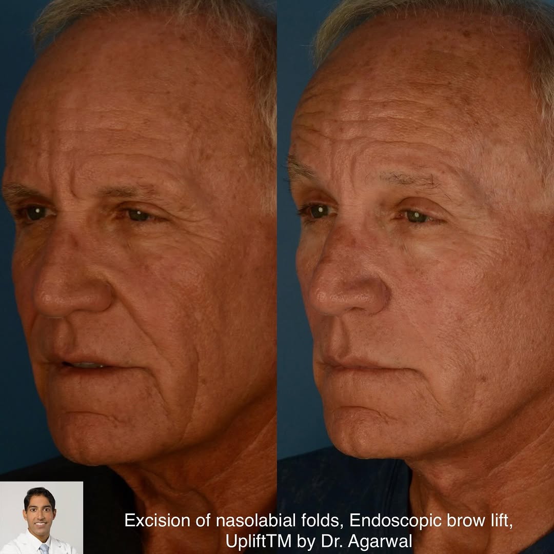 Instagram post by Dr. Anurag Agarwal: 66 year old gentleman who didn’t like his deep nasolabial folds, and the sagging of his cheeks, jawline and neck. He is shown before and 6 m…