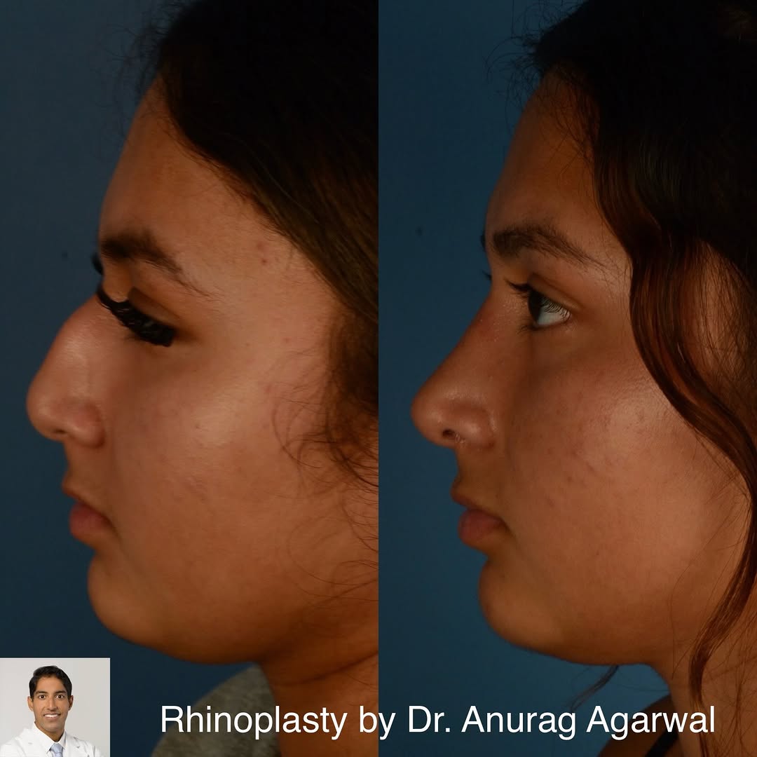 Instagram post by Dr. Anurag Agarwal: This 17 year old woman was self-conscious about her appearance because of her nose. She is shown before and 8 months after I performed an ex…