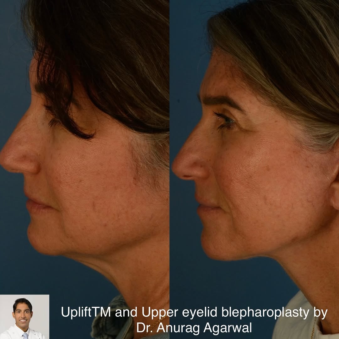 Instagram post by Dr. Anurag Agarwal: I was happy to see my 54 year old patient, shown before and 6 months after I performed : ✅ UpliftTM lower face and neck lift with platysmapl…