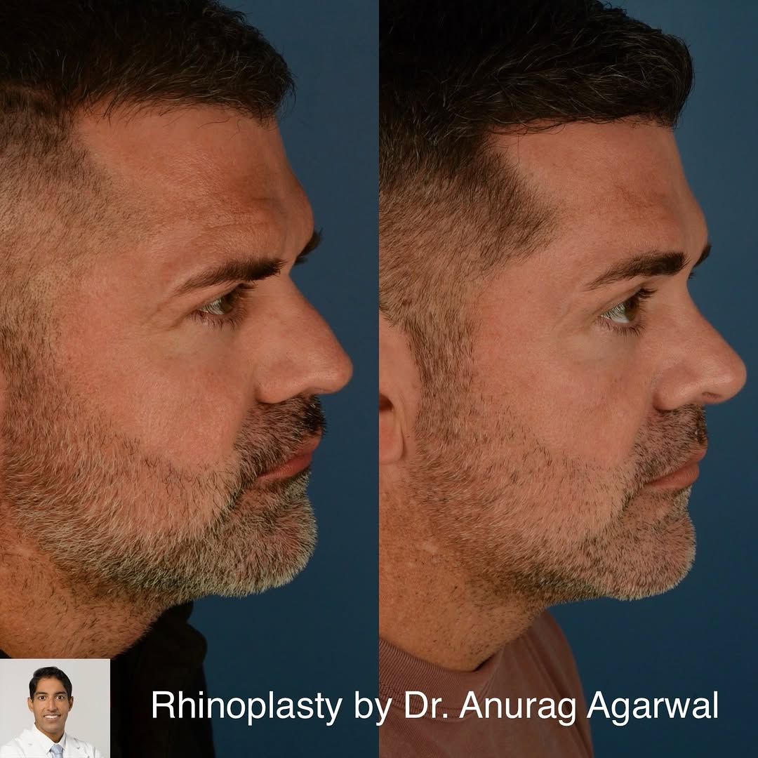 Instagram post by Dr. Anurag Agarwal: 1 year after an external rhinoplasty with septoplasty. This is a 45 year old gentleman who had a wide nasal bridge, lack of tip cartilage su…