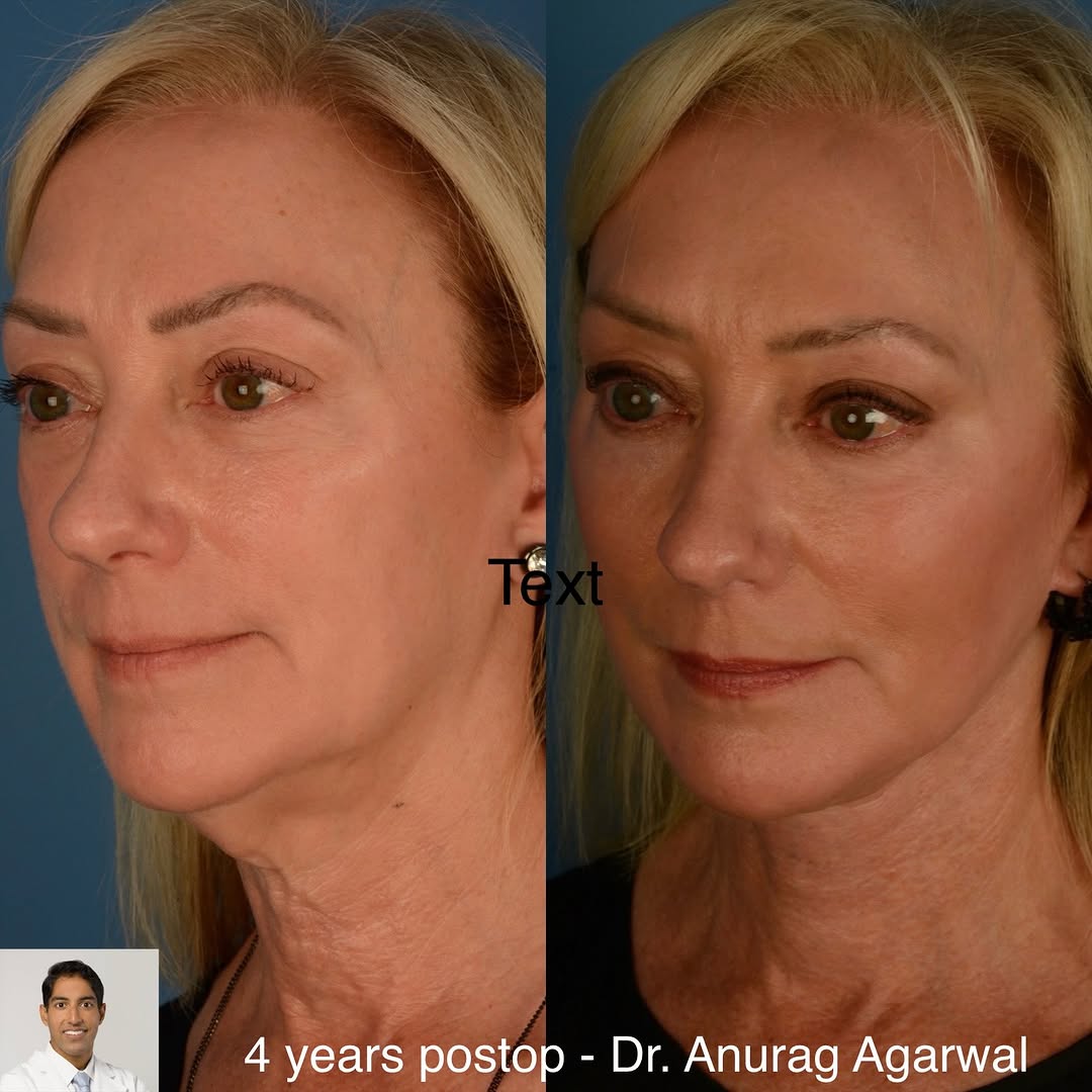 Instagram post by Dr. Anurag Agarwal: At 4 years post-op, this 65 year old woman still has excellent face, jawline and neck contour. She hasn’t had any fillers since her surgical…
