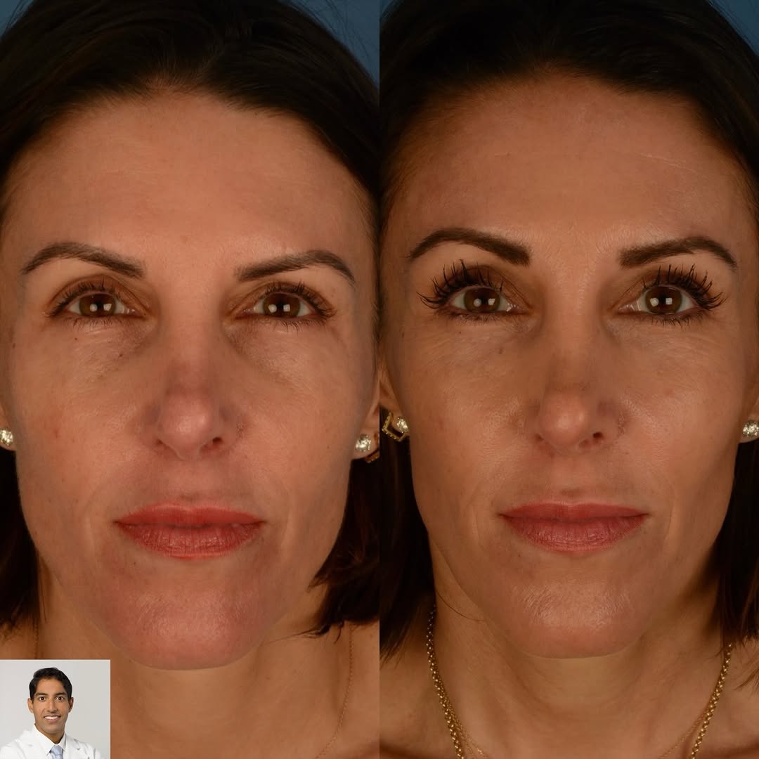 Instagram post by Dr. Anurag Agarwal: 1 year after periorbital rejuvenation for this 45 year old woman, her eye area looks refreshed and vibrant. Her eyebrows are in better posit…