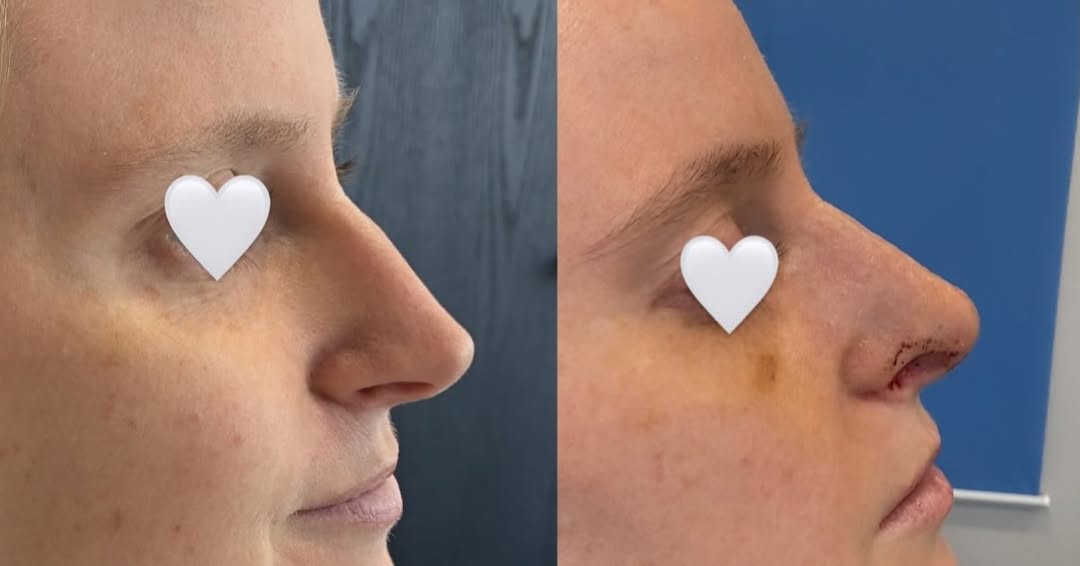 Instagram post by Dr. Anya Kishinevsky: ✨ One week after rhinoplasty. A look at her early transformation at just 1 week post-op. Swelling is still a normal part of the healing proc…
