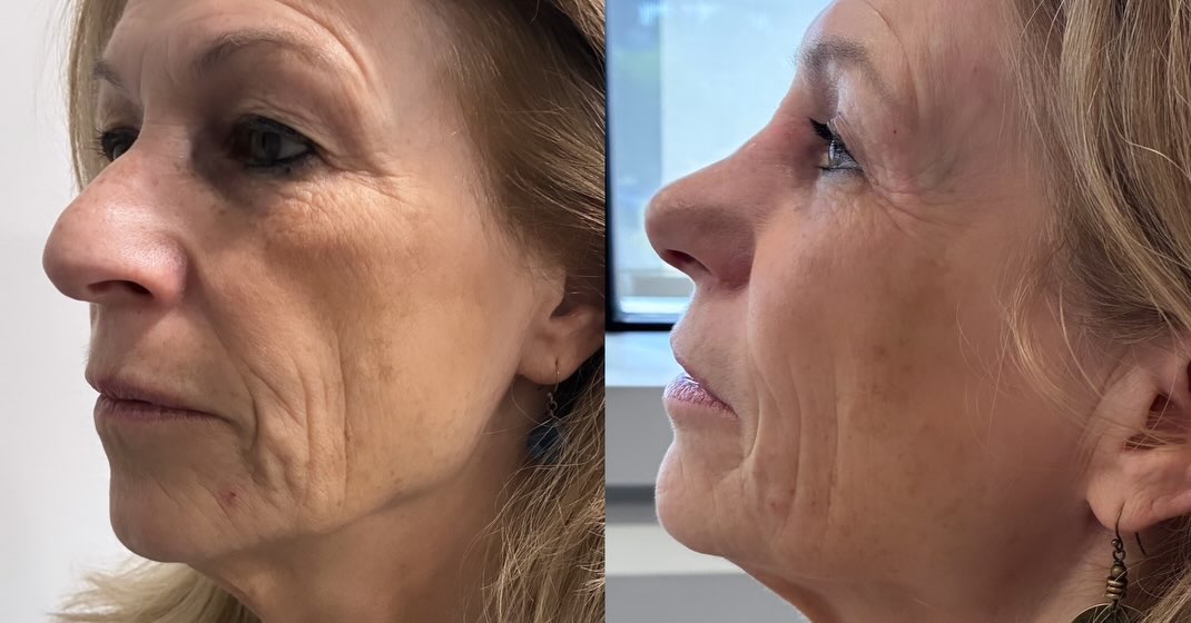 Instagram post by Dr. Anya Kishinevsky: ✨ Upper Blepharoplasty + Rhinoplasty Before & After ✨ A beautiful example of how subtle, thoughtfully planned changes can create greater har…