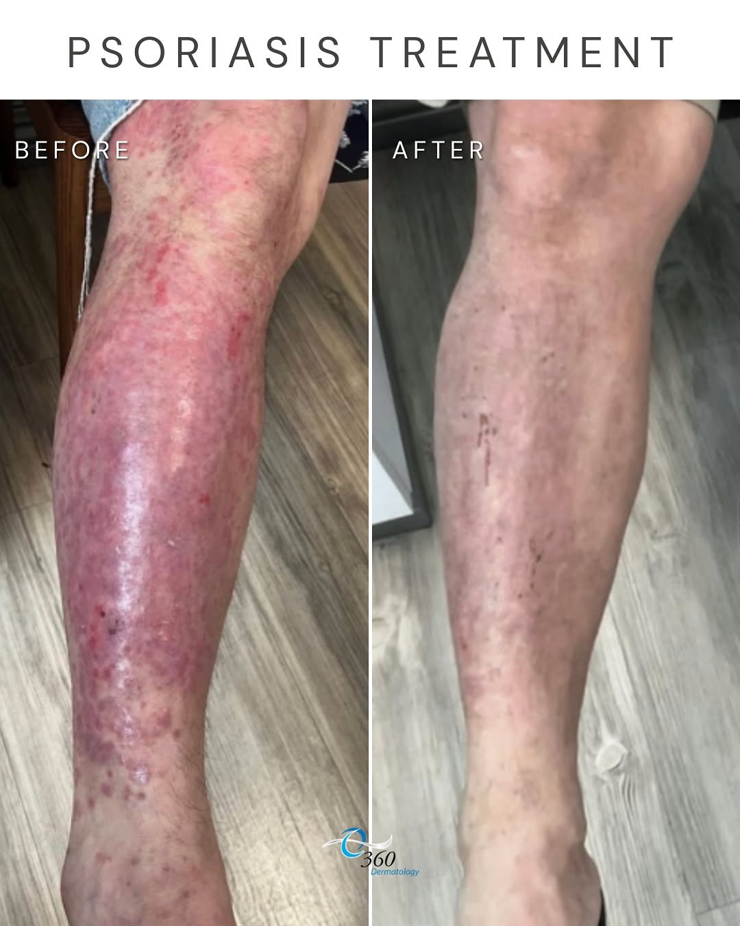 Instagram post by Dr. Aparna Ambay: This before-and-after shows the improvement one of our patients achieved after starting injectable treatment. Medications like guselkumab wo…