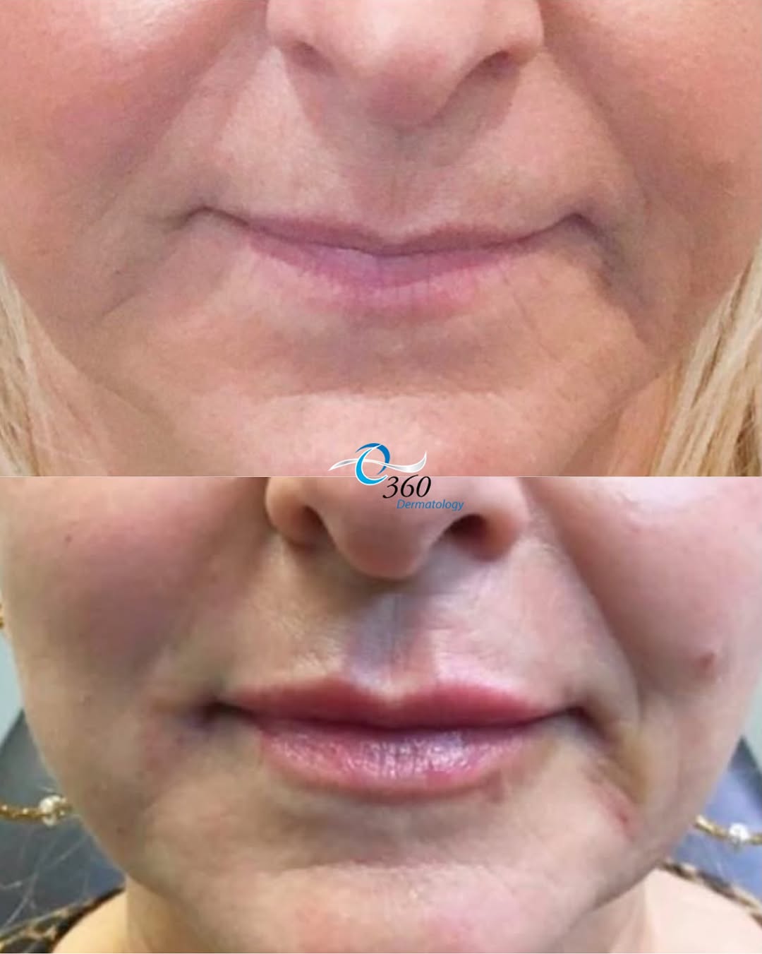 Instagram post by Dr. Aparna Ambay: A little filler, a lot of confidence 💋